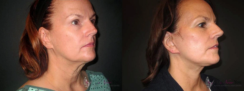 Real Patient Results by Dr. Shah of A New You Plastic Surgery & Medical Spa in Chicago, IL