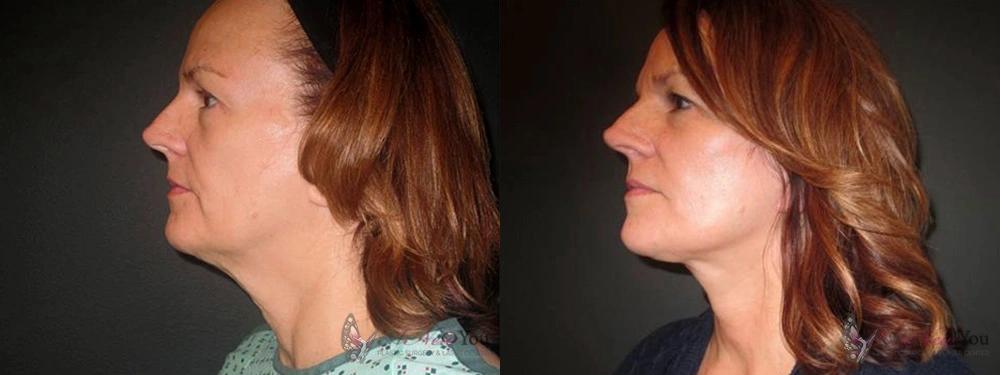 Real Patient Results by Dr. Shah of A New You Plastic Surgery & Medical Spa in Chicago, IL