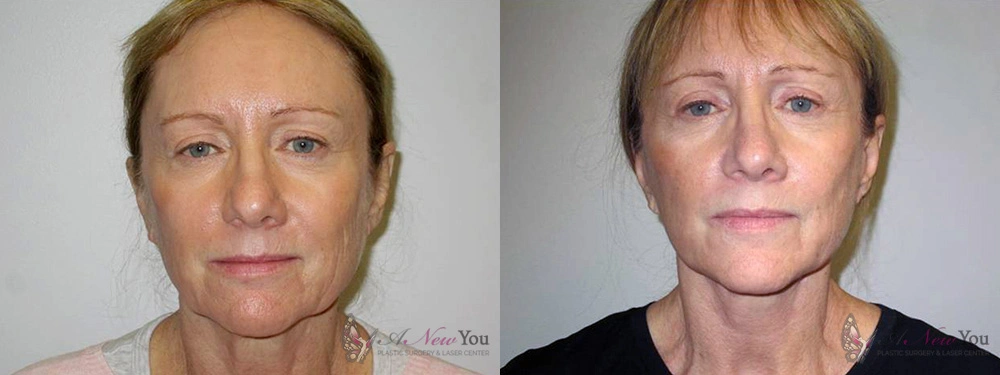Real Patient Results by Dr. Shah of A New You Plastic Surgery & Medical Spa in Chicago, IL