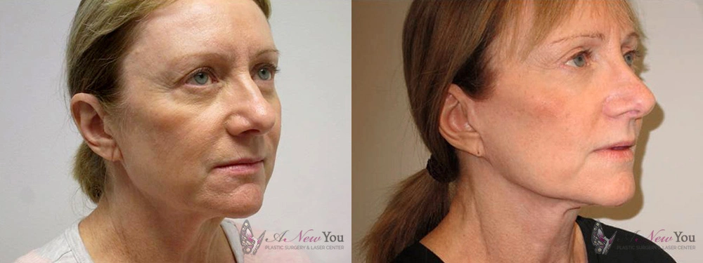 Real Patient Results by Dr. Shah of A New You Plastic Surgery & Medical Spa in Chicago, IL