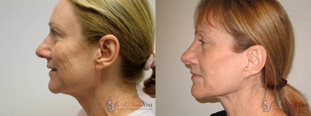 Real Patient Results by Dr. Shah of A New You Plastic Surgery & Medical Spa in Chicago, IL
