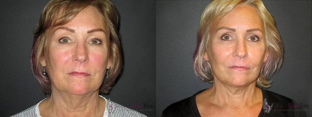 Real Patient Results by Dr. Shah of A New You Plastic Surgery & Medical Spa in Chicago, IL