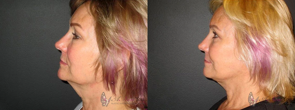 Real Patient Results by Dr. Shah of A New You Plastic Surgery & Medical Spa in Chicago, IL