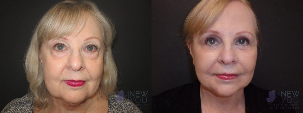 Real Patient Results by Dr. Shah of A New You Plastic Surgery & Medical Spa in Chicago, IL