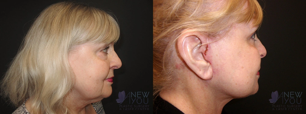 Real Patient Results by Dr. Shah of A New You Plastic Surgery & Medical Spa in Chicago, IL
