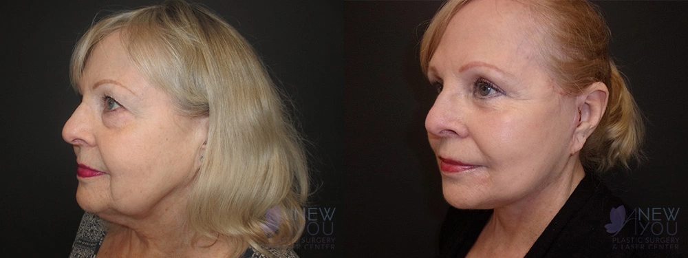 Real Patient Results by Dr. Shah of A New You Plastic Surgery & Medical Spa in Chicago, IL