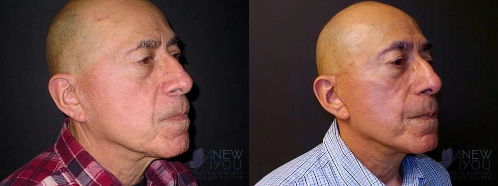 Real Patient Results by Dr. Shah of A New You Plastic Surgery & Medical Spa in Chicago, IL