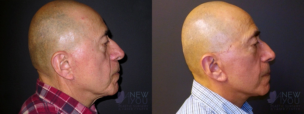 Real Patient Results by Dr. Shah of A New You Plastic Surgery & Medical Spa in Chicago, IL