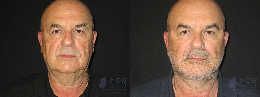 Real Patient Results by Dr. Shah of A New You Plastic Surgery & Medical Spa in Chicago, IL