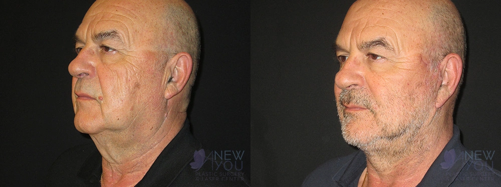 Real Patient Results by Dr. Shah of A New You Plastic Surgery & Medical Spa in Chicago, IL