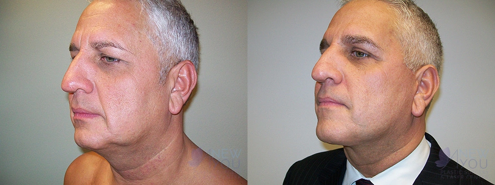 Real Patient Results by Dr. Shah of A New You Plastic Surgery & Medical Spa in Chicago, IL
