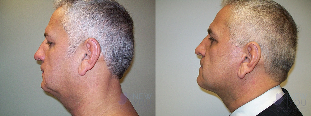 Real Patient Results by Dr. Shah of A New You Plastic Surgery & Medical Spa in Chicago, IL
