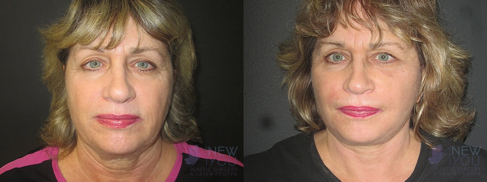 Real Patient Results by Dr. Shah of A New You Plastic Surgery & Medical Spa in Chicago, IL