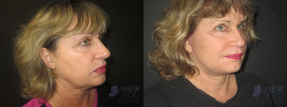 Real Patient Results by Dr. Shah of A New You Plastic Surgery & Medical Spa in Chicago, IL