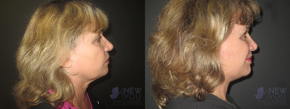 Real Patient Results by Dr. Shah of A New You Plastic Surgery & Medical Spa in Chicago, IL