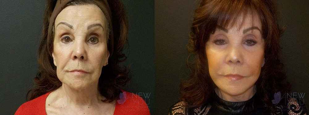 Real Patient Results by Dr. Shah of A New You Plastic Surgery & Medical Spa in Chicago, IL