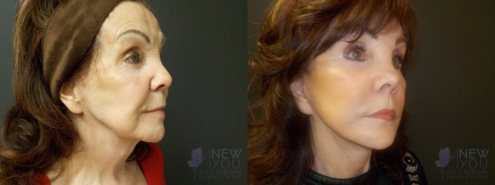 Real Patient Results by Dr. Shah of A New You Plastic Surgery & Medical Spa in Chicago, IL