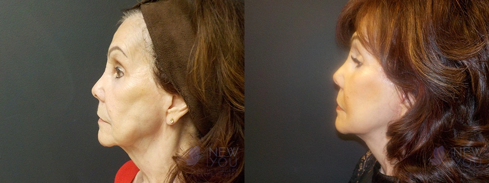 Real Patient Results by Dr. Shah of A New You Plastic Surgery & Medical Spa in Chicago, IL