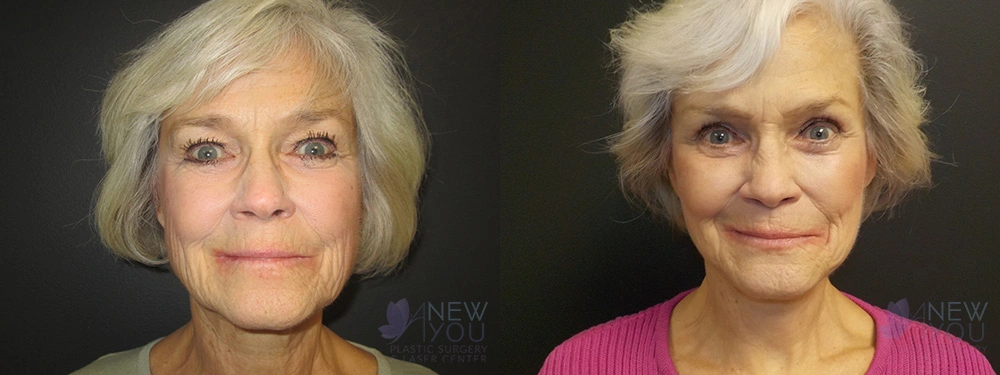 Real Patient Results by Dr. Shah of A New You Plastic Surgery & Medical Spa in Chicago, IL