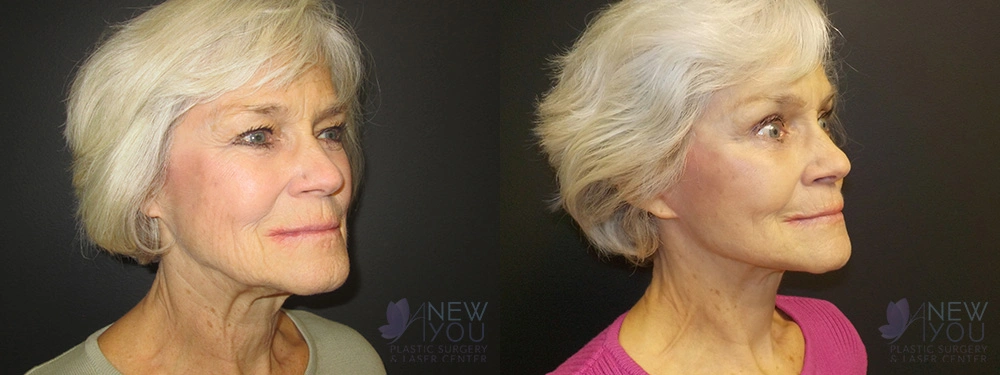Real Patient Results by Dr. Shah of A New You Plastic Surgery & Medical Spa in Chicago, IL