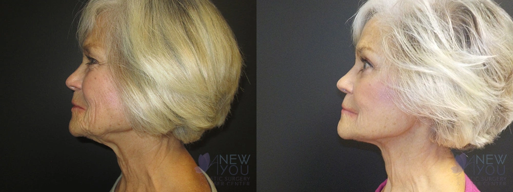 Real Patient Results by Dr. Shah of A New You Plastic Surgery & Medical Spa in Chicago, IL