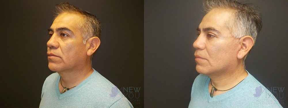 Real Patient Results by Dr. Shah of A New You Plastic Surgery & Medical Spa in Chicago, IL