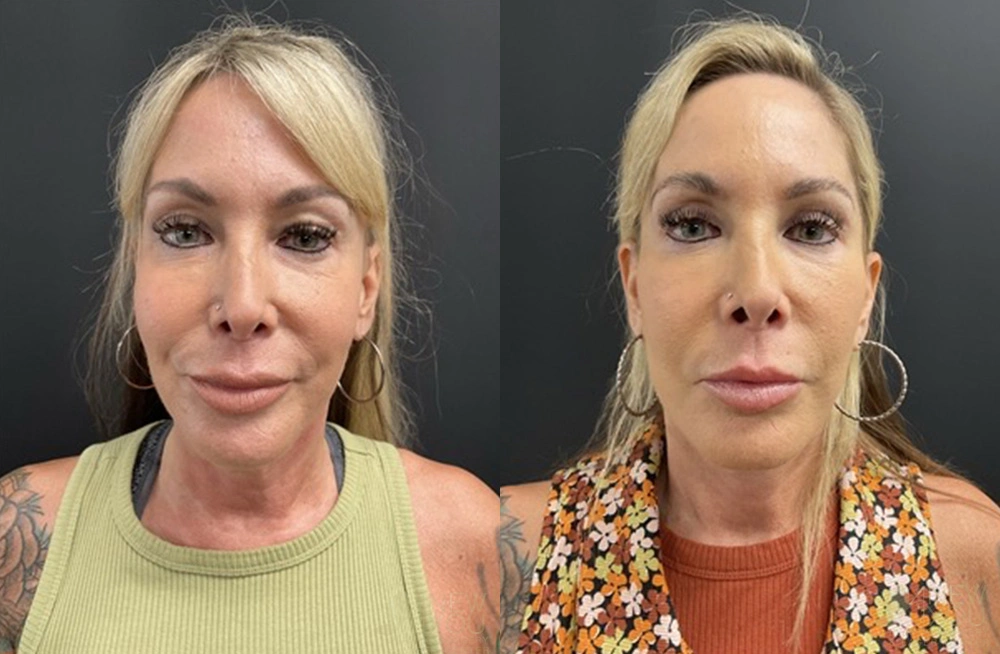 Real Patient Results by Dr. Shah of A New You Plastic Surgery & Medical Spa in Chicago, IL