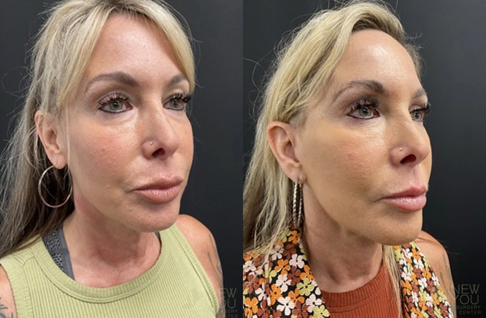 Real Patient Results by Dr. Shah of A New You Plastic Surgery & Medical Spa in Chicago, IL