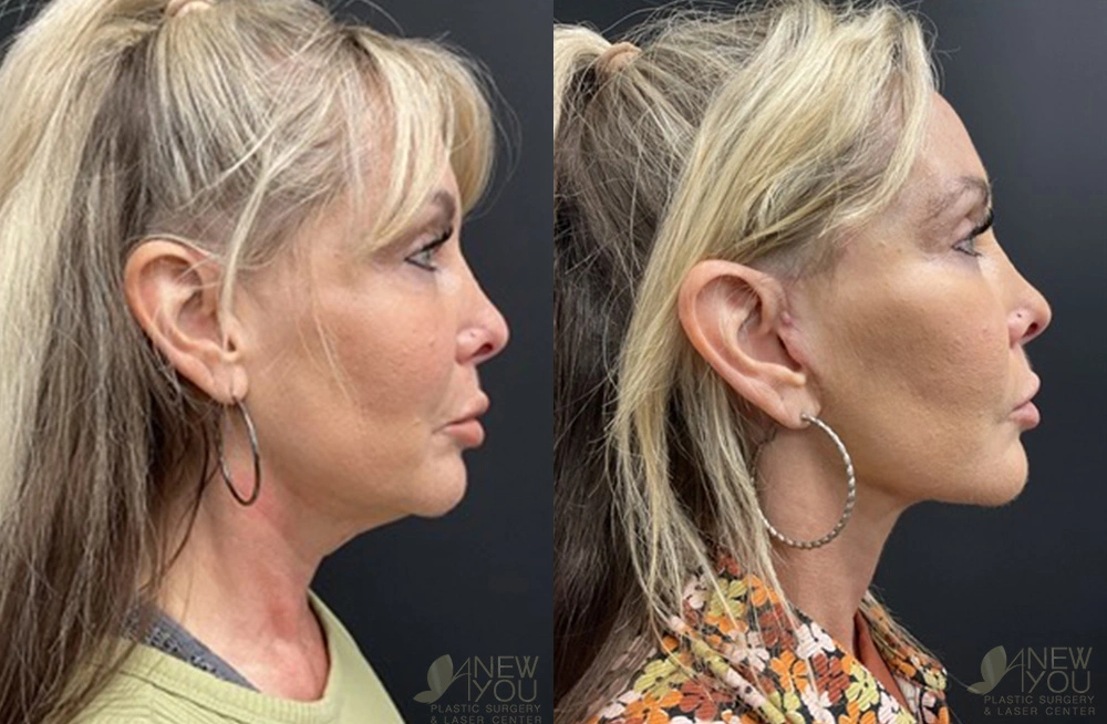 Real Patient Results by Dr. Shah of A New You Plastic Surgery & Medical Spa in Chicago, IL