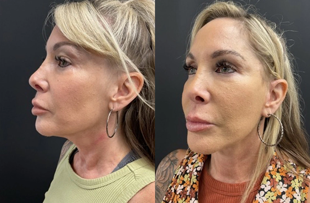 Real Patient Results by Dr. Shah of A New You Plastic Surgery & Medical Spa in Chicago, IL