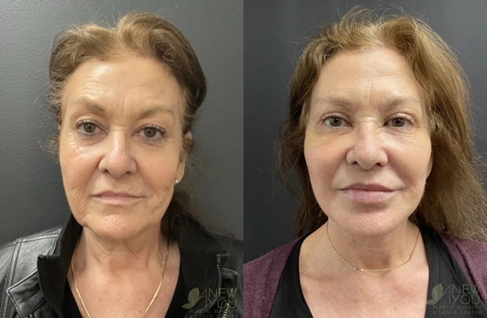 Real Patient Results by Dr. Shah of A New You Plastic Surgery & Medical Spa in Chicago, IL