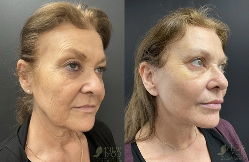 Real Patient Results by Dr. Shah of A New You Plastic Surgery & Medical Spa in Chicago, IL