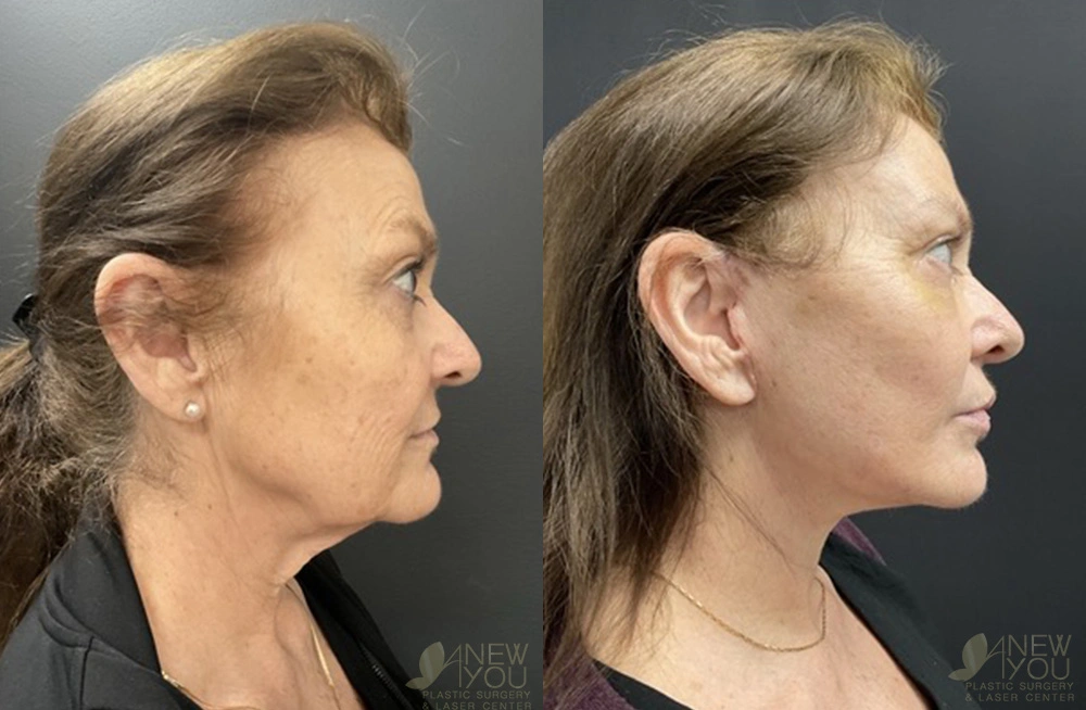 Real Patient Results by Dr. Shah of A New You Plastic Surgery & Medical Spa in Chicago, IL
