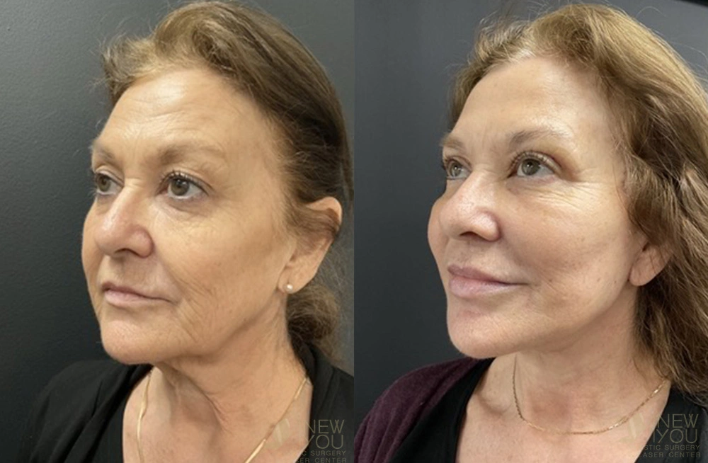 Real Patient Results by Dr. Shah of A New You Plastic Surgery & Medical Spa in Chicago, IL