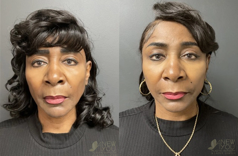 Real Patient Results by Dr. Shah of A New You Plastic Surgery & Medical Spa in Chicago, IL