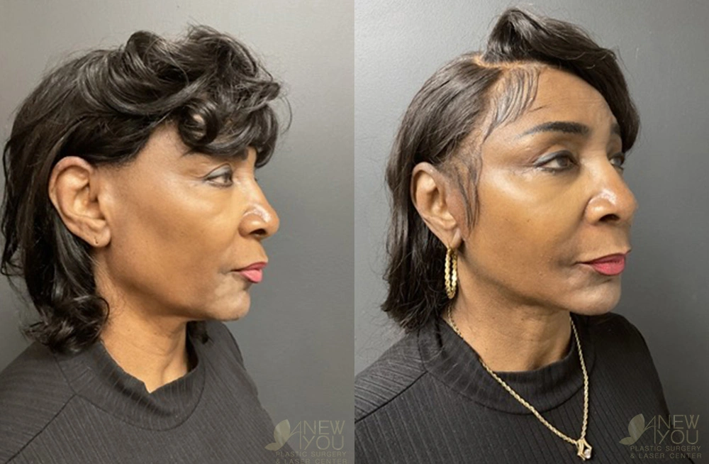 Real Patient Results by Dr. Shah of A New You Plastic Surgery & Medical Spa in Chicago, IL