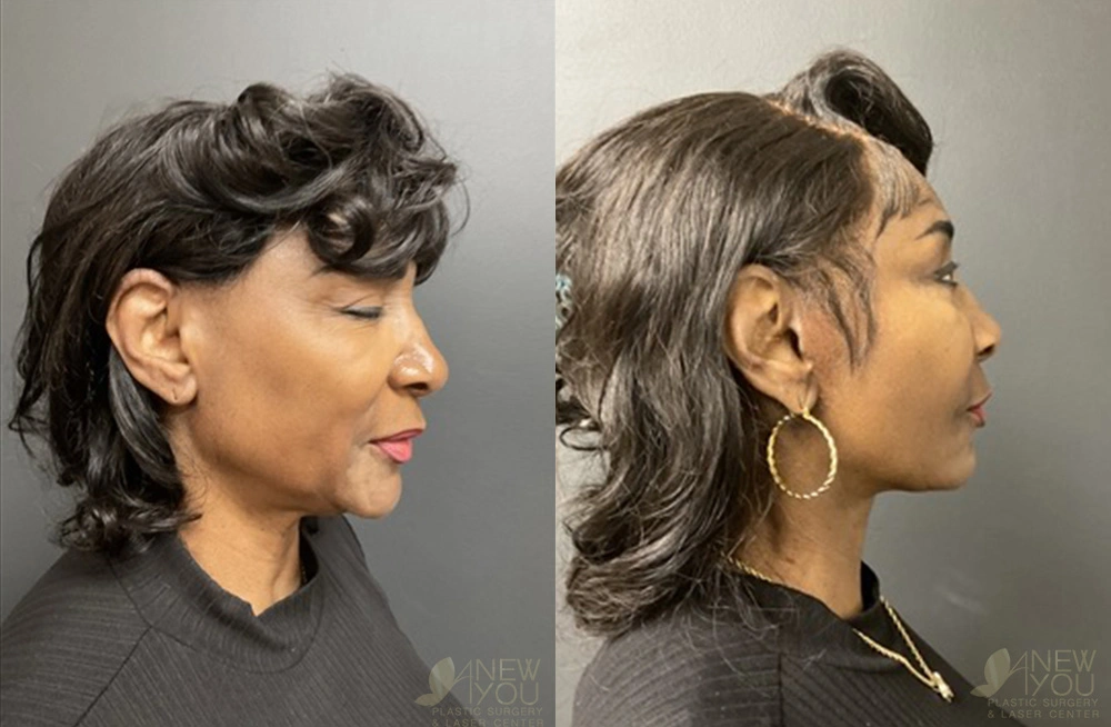 Real Patient Results by Dr. Shah of A New You Plastic Surgery & Medical Spa in Chicago, IL