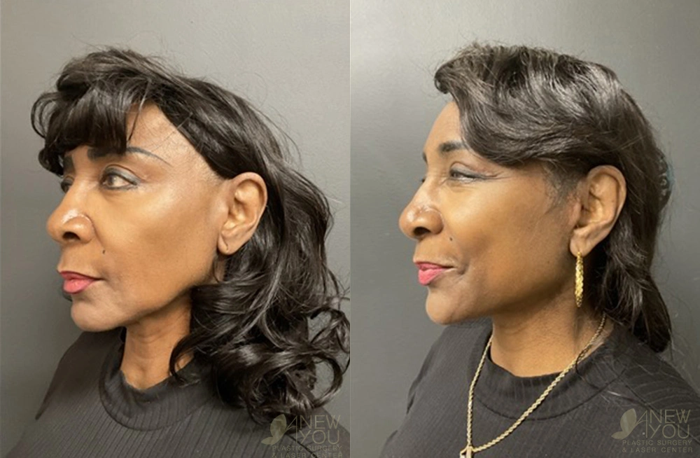 Real Patient Results by Dr. Shah of A New You Plastic Surgery & Medical Spa in Chicago, IL