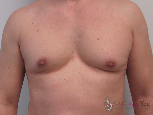 gynecomastia-01a-before