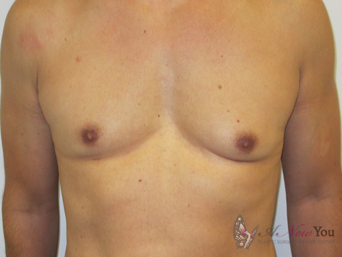 gynecomastia-01a-post