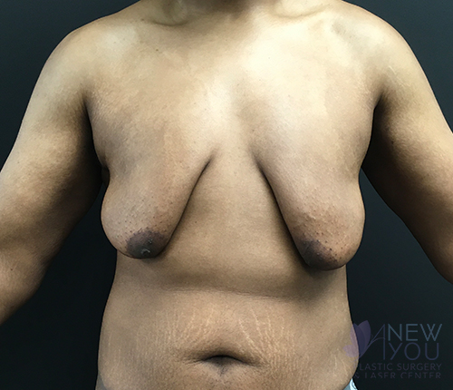 gynecomastia-07a-before