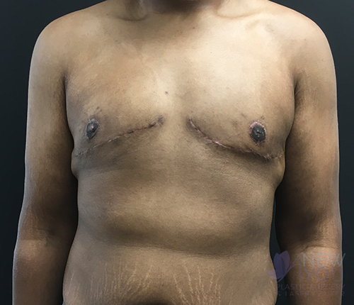 gynecomastia-07a-post