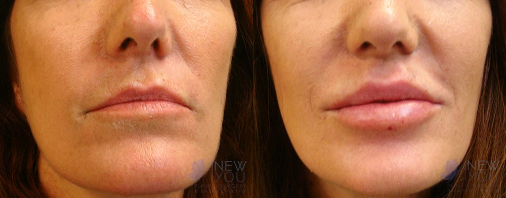 Real Patient Results by Dr. Shah of A New You Plastic Surgery & Medical Spa in Chicago, IL