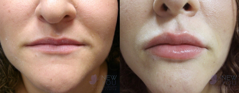 Real Patient Results by Dr. Shah of A New You Plastic Surgery & Medical Spa in Chicago, IL