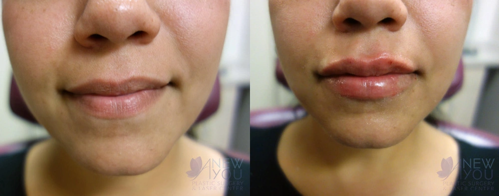 Real Patient Results by Dr. Shah of A New You Plastic Surgery & Medical Spa in Chicago, IL