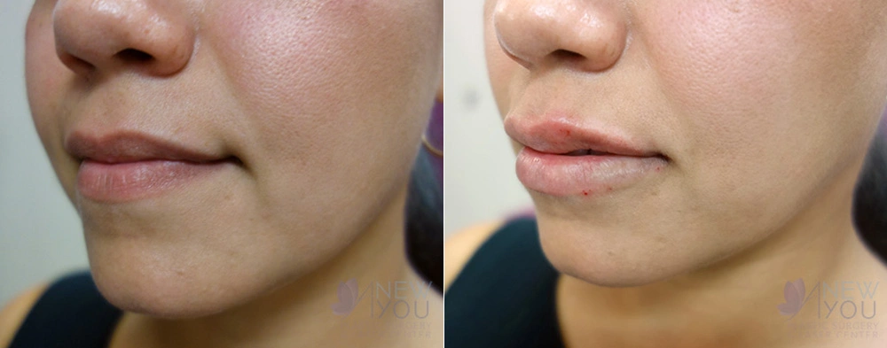 Real Patient Results by Dr. Shah of A New You Plastic Surgery & Medical Spa in Chicago, IL