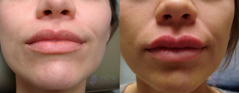 Real Patient Results by Dr. Shah of A New You Plastic Surgery & Medical Spa in Chicago, IL
