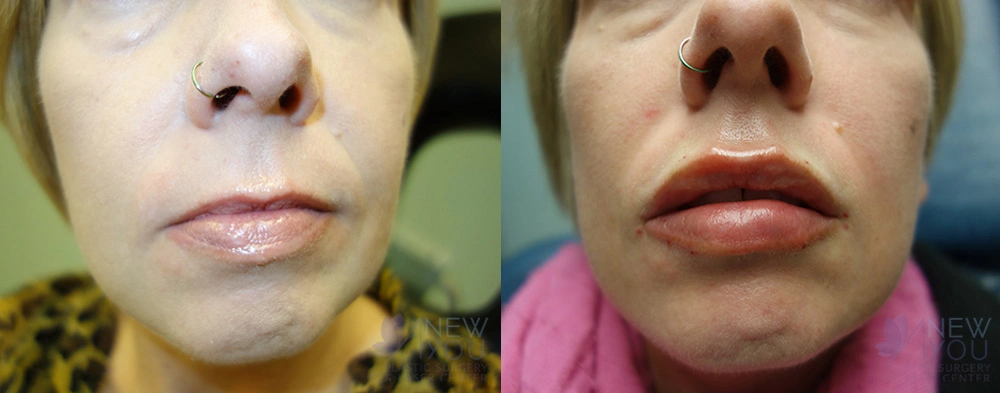 Real Patient Results by Dr. Shah of A New You Plastic Surgery & Medical Spa in Chicago, IL