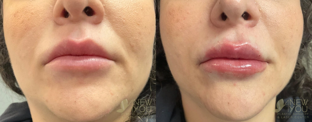 Real Patient Results by Dr. Shah of A New You Plastic Surgery & Medical Spa in Chicago, IL