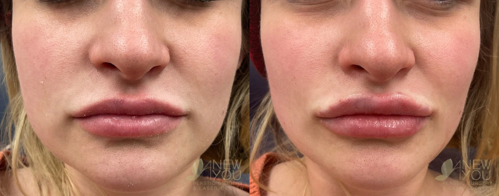 Real Patient Results by Dr. Shah of A New You Plastic Surgery & Medical Spa in Chicago, IL